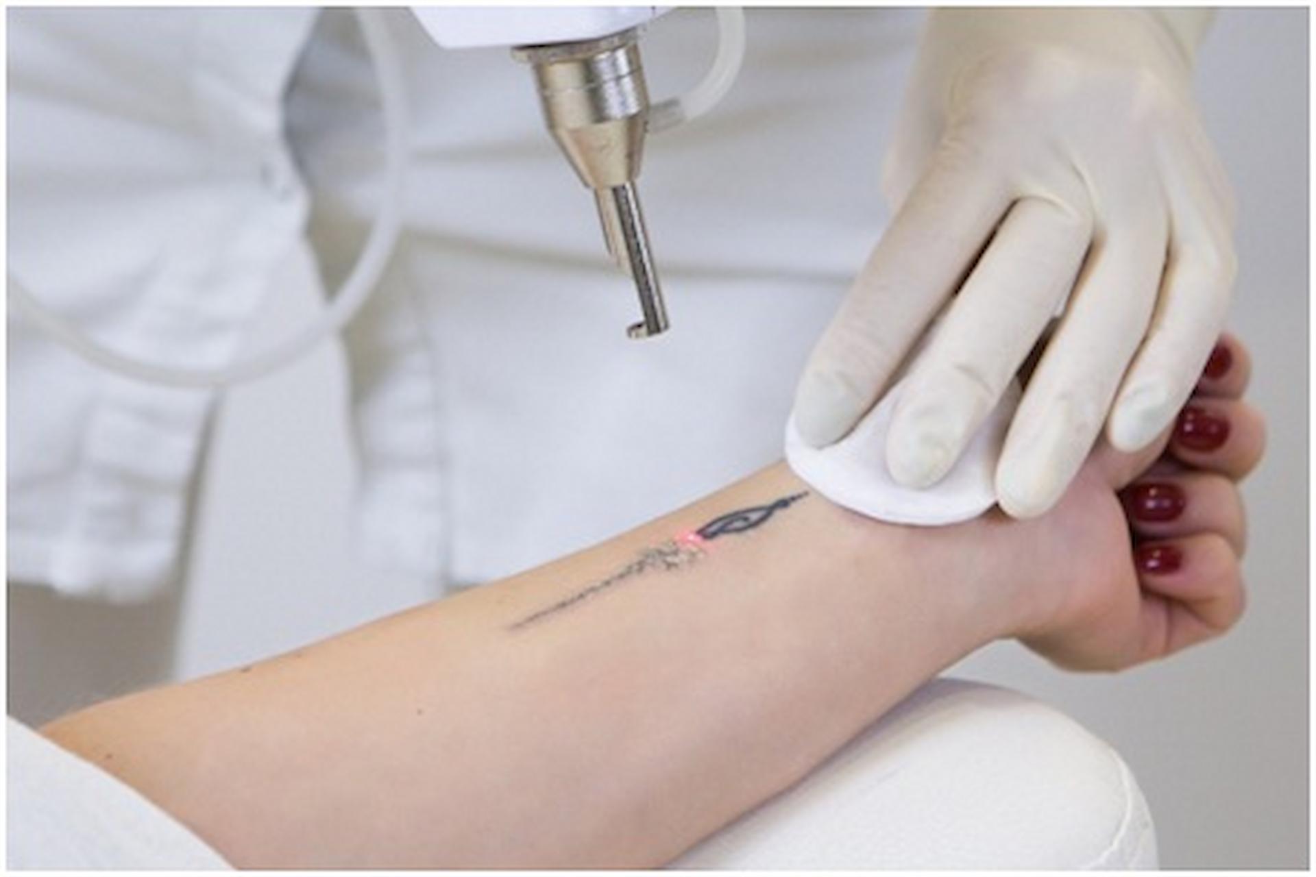 How To Book The Best Tattoo Removal Experts Locally?
